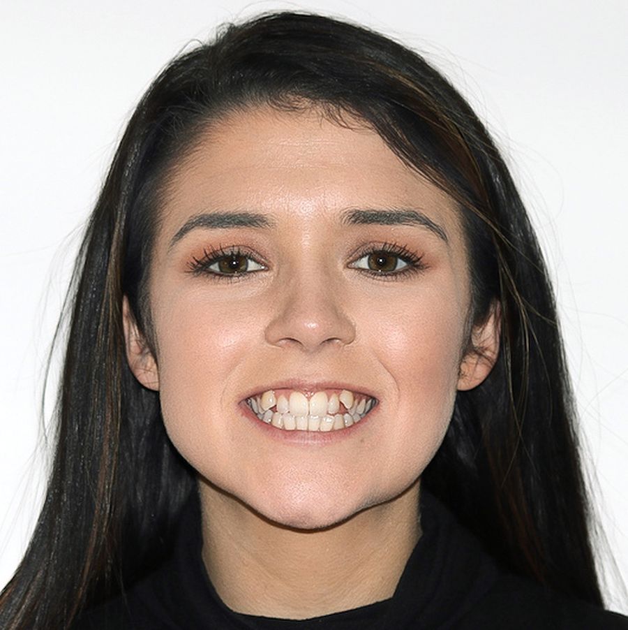Invisalign Before - Evelyn 